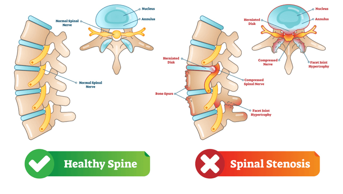 Ont i nacken - Spinal stenos