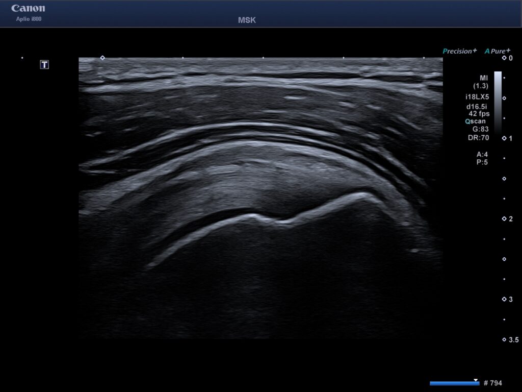 Ultraljud av axeln vid axelsmärta