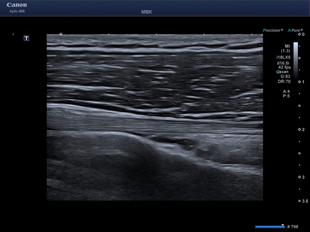Ultraljud axel – undersökning av senor och muskler