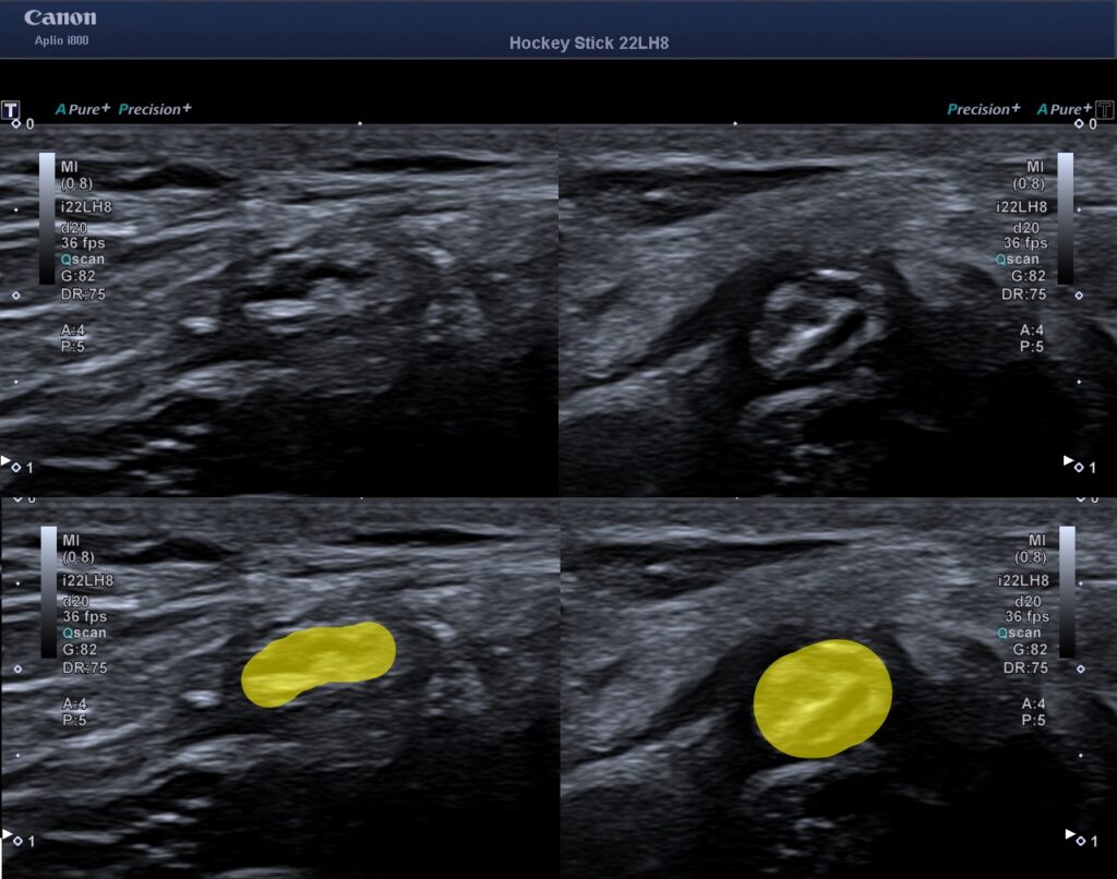 Ultraljudsundersökning vid meralgia paresthetica