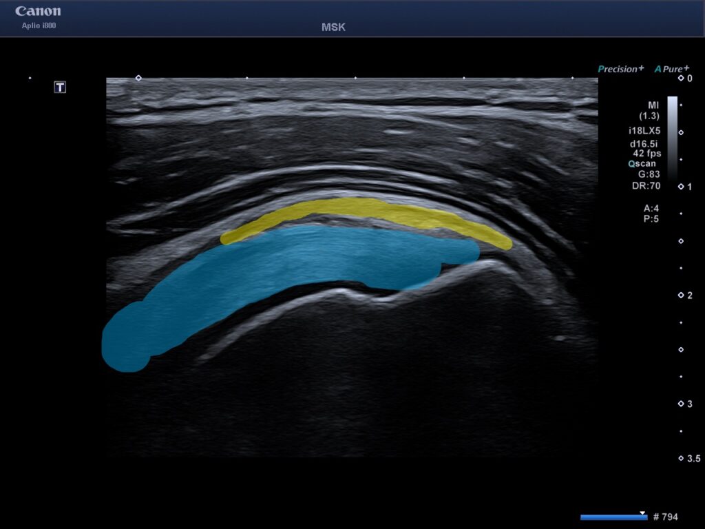 Ultraljud av axeln vid axelsmärta