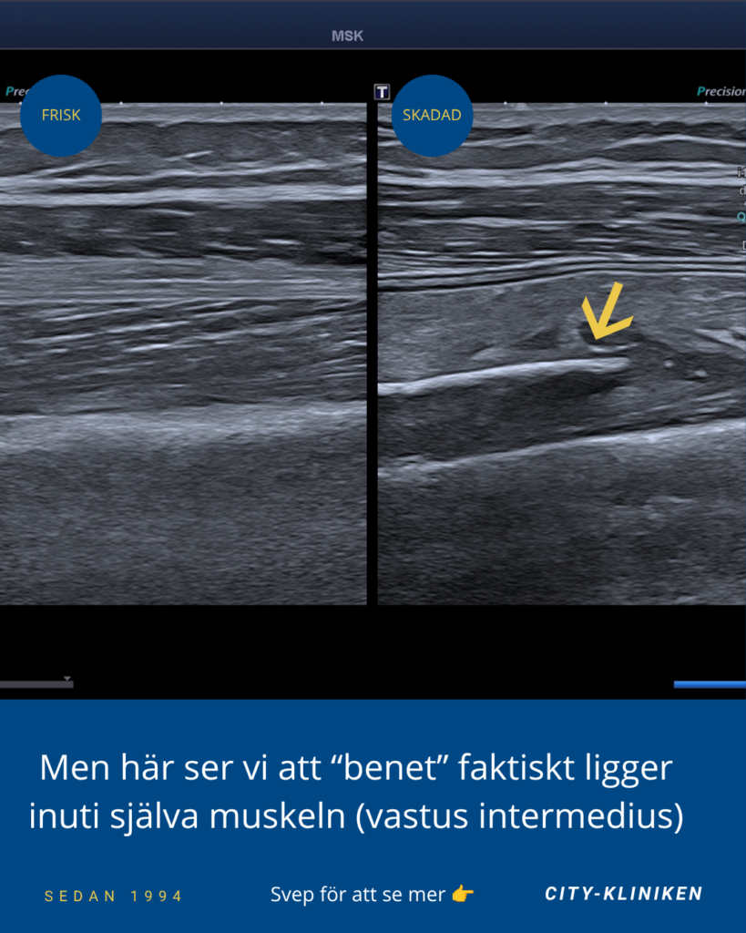 Ultraljudsdiagnostik av Myositis Ossificans där man tydligt ser att det inte är lårbenet, utan nybildat ben i muskulaturen vastus intermedius.