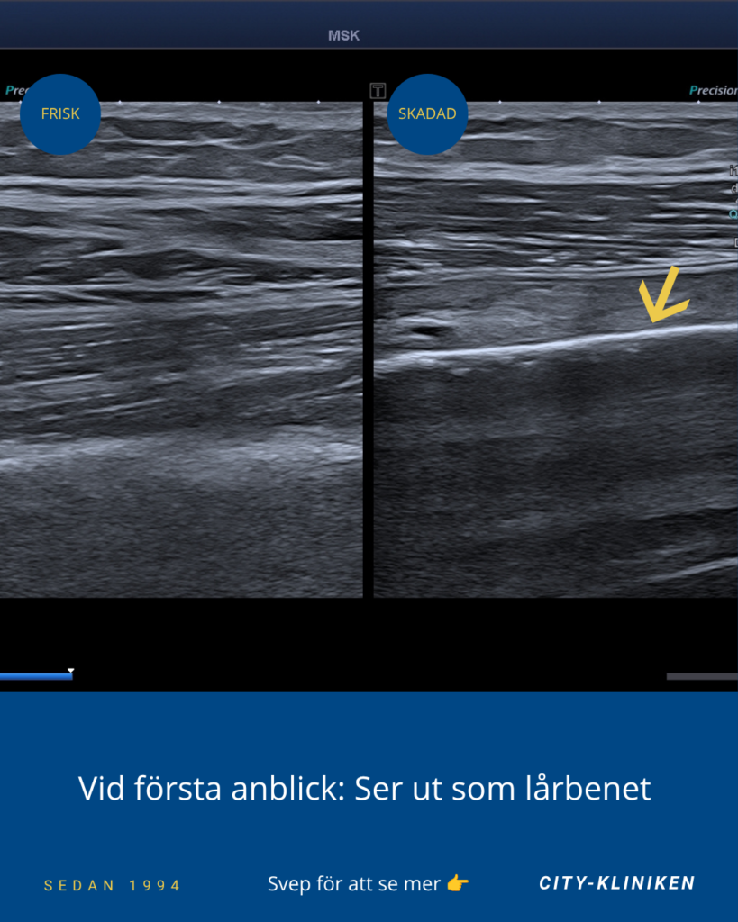 Ultraljudsdiagnostik av Myositis Ossificans som vid första anblick ser ut att vara lårbenet