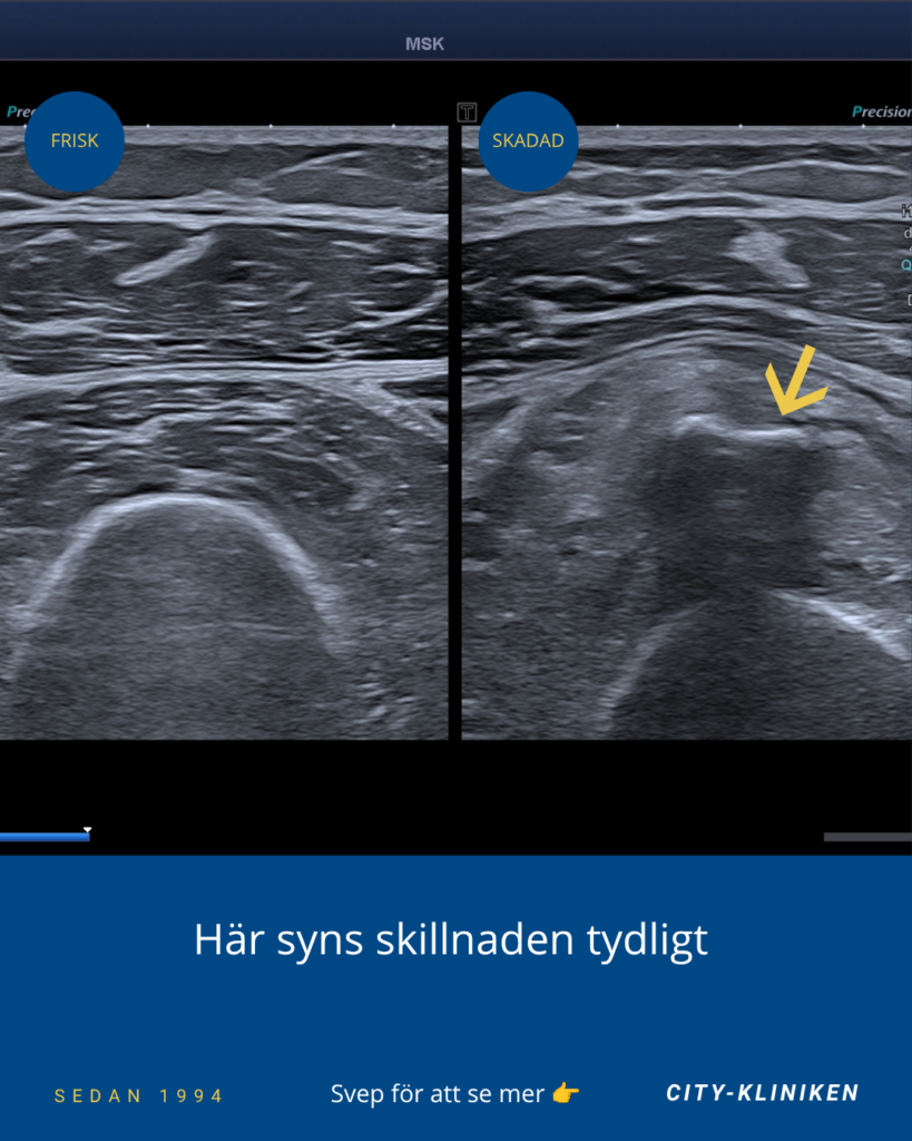 En bild i genomskärning vid ultraljudsdiagnostik av Myositis Ossificans på City-Kliniken i Göteborg.